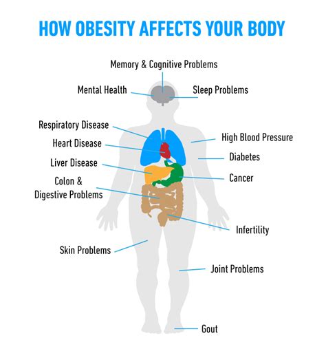 obease|Obesity (Excessively Overweight): Health Effects and。